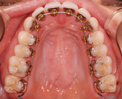 裏側からの矯正治療上