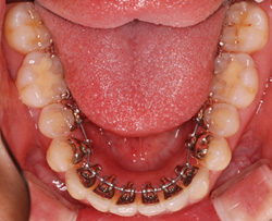 裏側からの矯正治療下