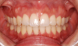 裏側からの矯正治療