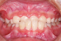 反対咬合 治療前