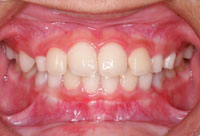 反対咬合 治療後