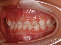 乳歯列での反対咬合 治療前