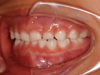 乳歯列での反対咬合 治療後