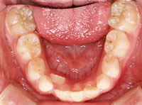 下の前歯のスペースが足りない 治療前