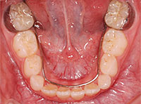 下の前歯のスペースが足りない 治療後