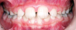 前歯が出ている 治療後