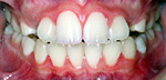 前歯が開いている(上下の歯が咬み合わない) 治療後
