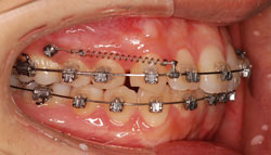 矯正用アンカースクリューが入っているところ