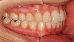 矯正用アンカースクリュー除去後