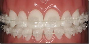 セラミックブラケット